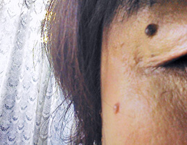 ほくろ・いぼ・盛り上がったシミ(脂漏性角化症)