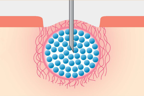 再びCO2ガスを注入し薬剤を分散